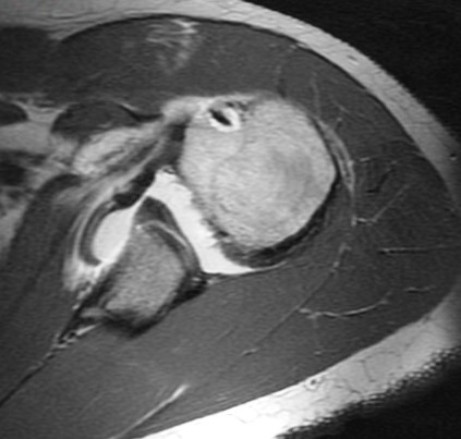 Figure 5 for case SLAP lesion with labral cyst and suprascapular nerve compression Also nearly circumferential labral tear